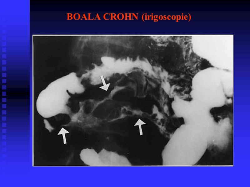 BOALA CROHN (irigoscopie)